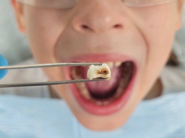 Best Chipped Tooth Repair Near Me  in Anaconda, MT